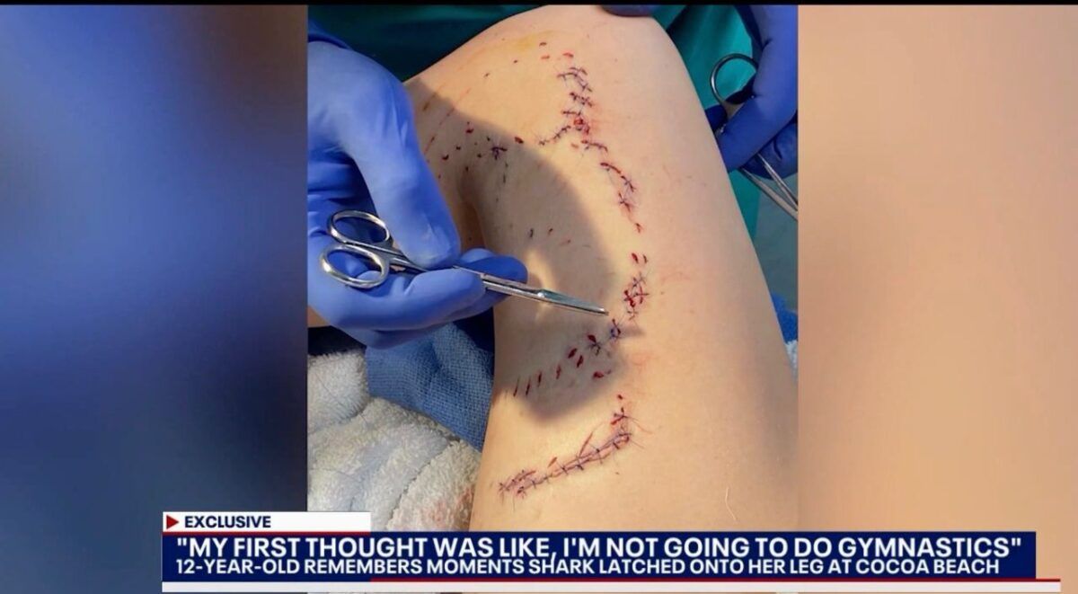 Shark Bite at Florida Beach