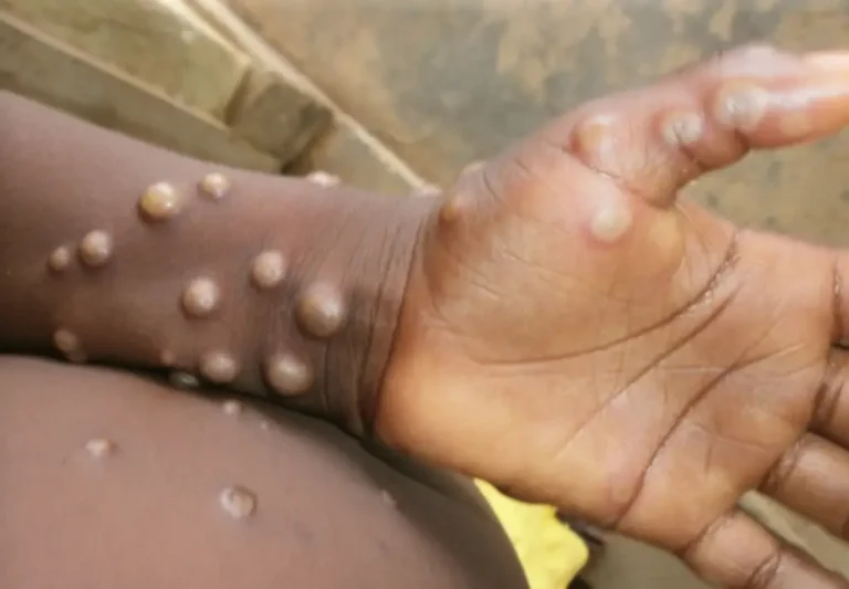 mpx monkeypox cr Nigeria Centre for Disease Control