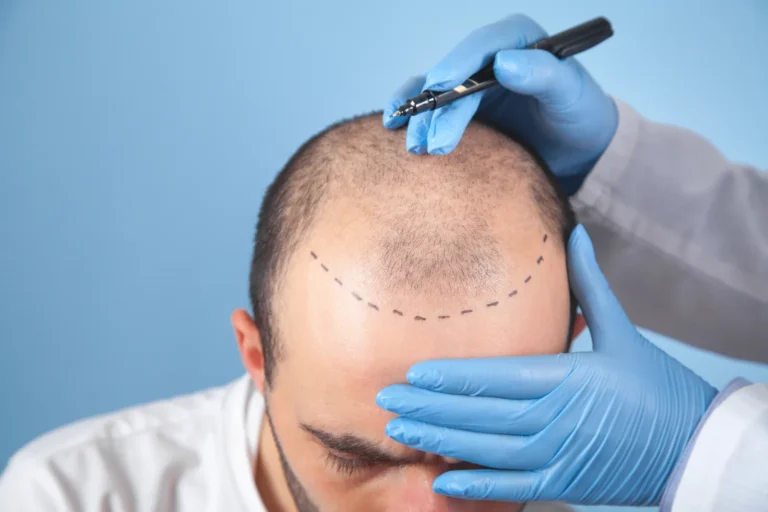 Doctor marking hairline on patient's scalp before hair transplant procedure